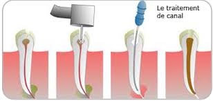 traitement du canal dentaire