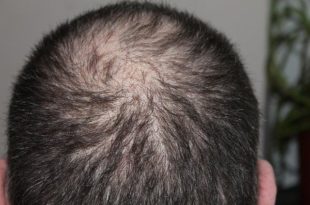 Comment lutter naturellement contre les chutes excessives de cheveux