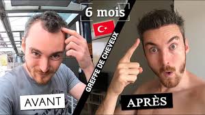 greffe cheveux