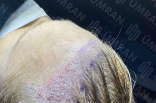 greffe de cheveux en Turquie