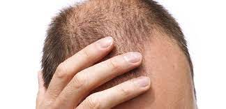 Découvrez les principales différences entre la chute de cheveux temporaire et permanente, leurs causes, symptômes et solutions. Informez-vous pour mieux agir!